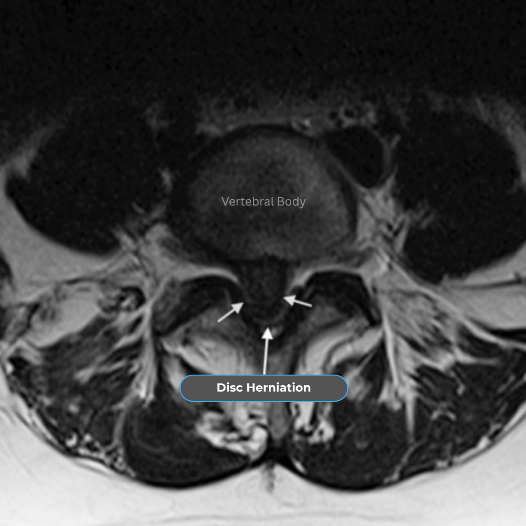 Axial T2 MRI